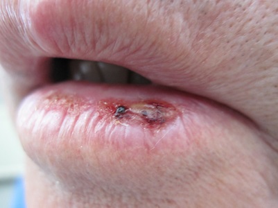 Huidkanker vorm op lip genaamd plaveiselcelcarcinoom