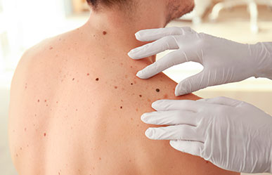 Aantal_diagnoses_huidkanker_stijgt_ad