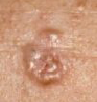 Basaalcelcarcinoom