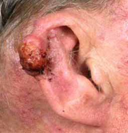 Plaveiselcelcarcinoom
